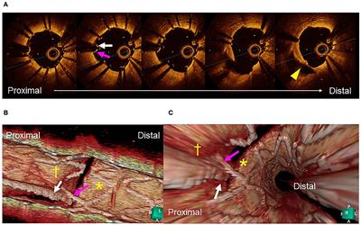 How to use three-dimensional optical coherence tomography effectively in coronary bifurcation stenting